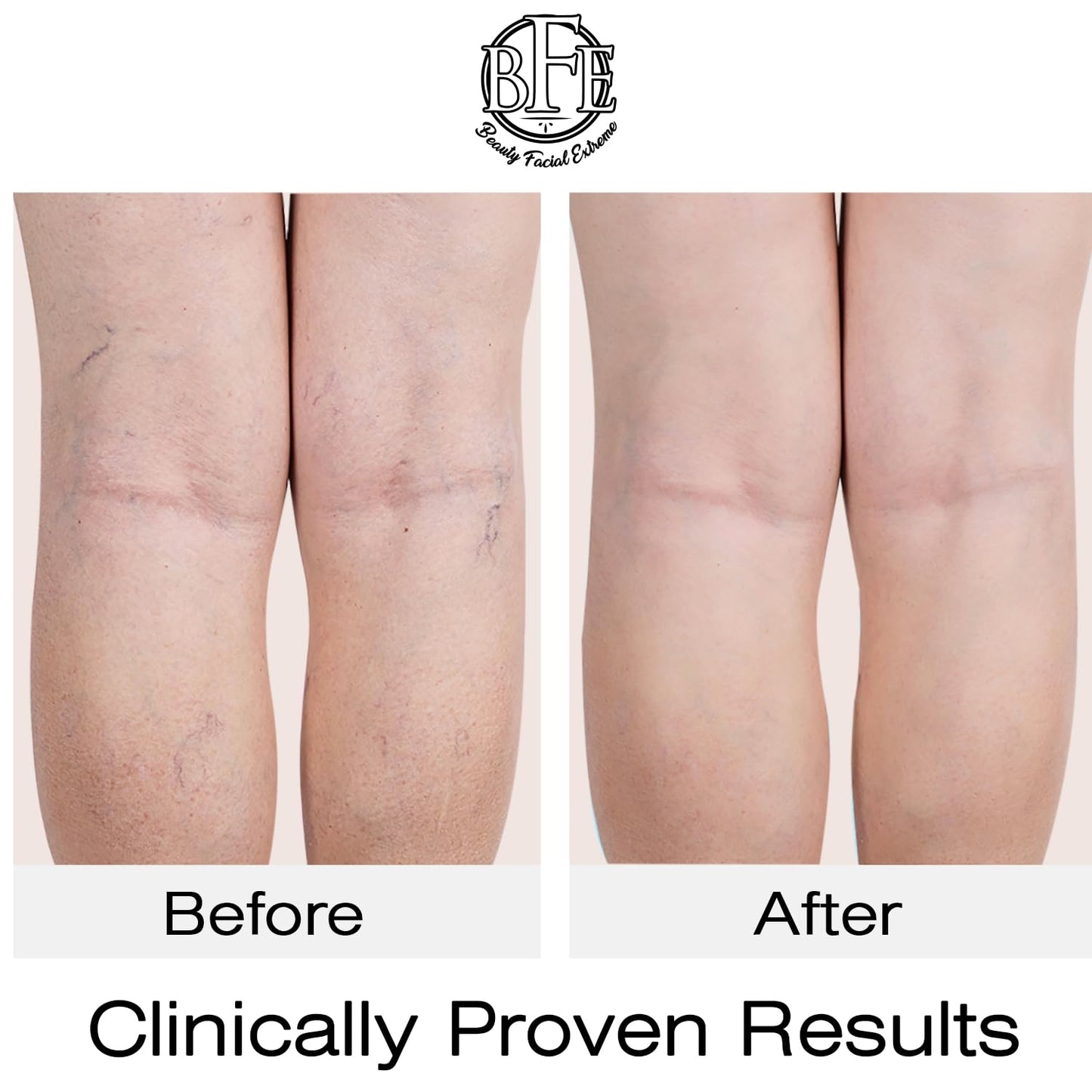 Vitamin K Cream- Moisturizing Bruise Healing Formula. Dark Spot Corrector for Bruising, Spider Veins & Broken Capillaries. Reduces Under Eye Dark Circles, Fine Lines, Puffiness, & Wrinkles.