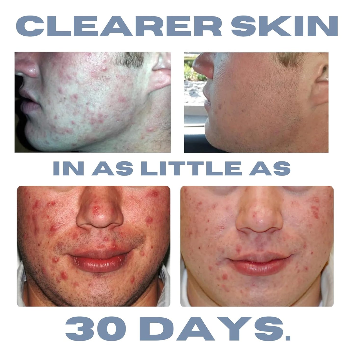 Acne Lotion with Benzoyl Peroxide, Acne Cream, Face Moisturizer Acne Prone Skin, Acne Moisturizer for Face, 1.8 Fl oz