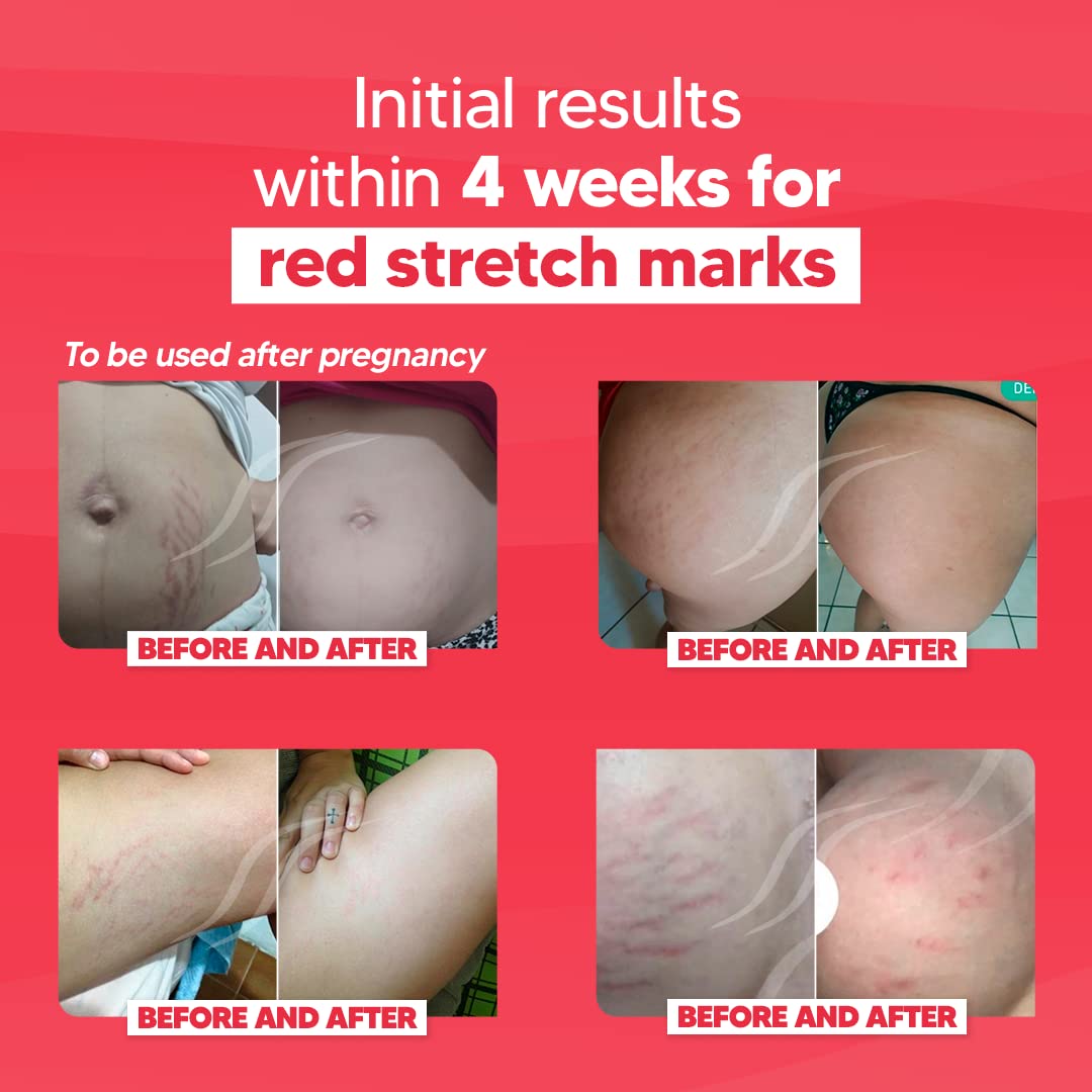 Cicatrissim Red For Removal of Red and Purple Stretch Marks - Innovative Formula With Pure and Powerful Natural Ingredients From Brazilian Flora - For All Skin Types.