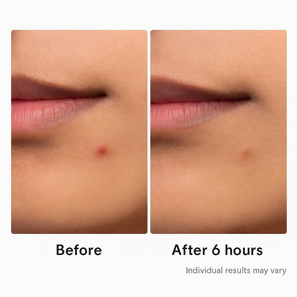 Hydrocolloid Acne Pimple Patch – 72 Count (9mm & 12mm) | Invisible Spot Patches for Pimples, Zits, Blemishes & Whiteheads | Fast Healing, Waterproof, Strong Adhesion & Gentle on Skin