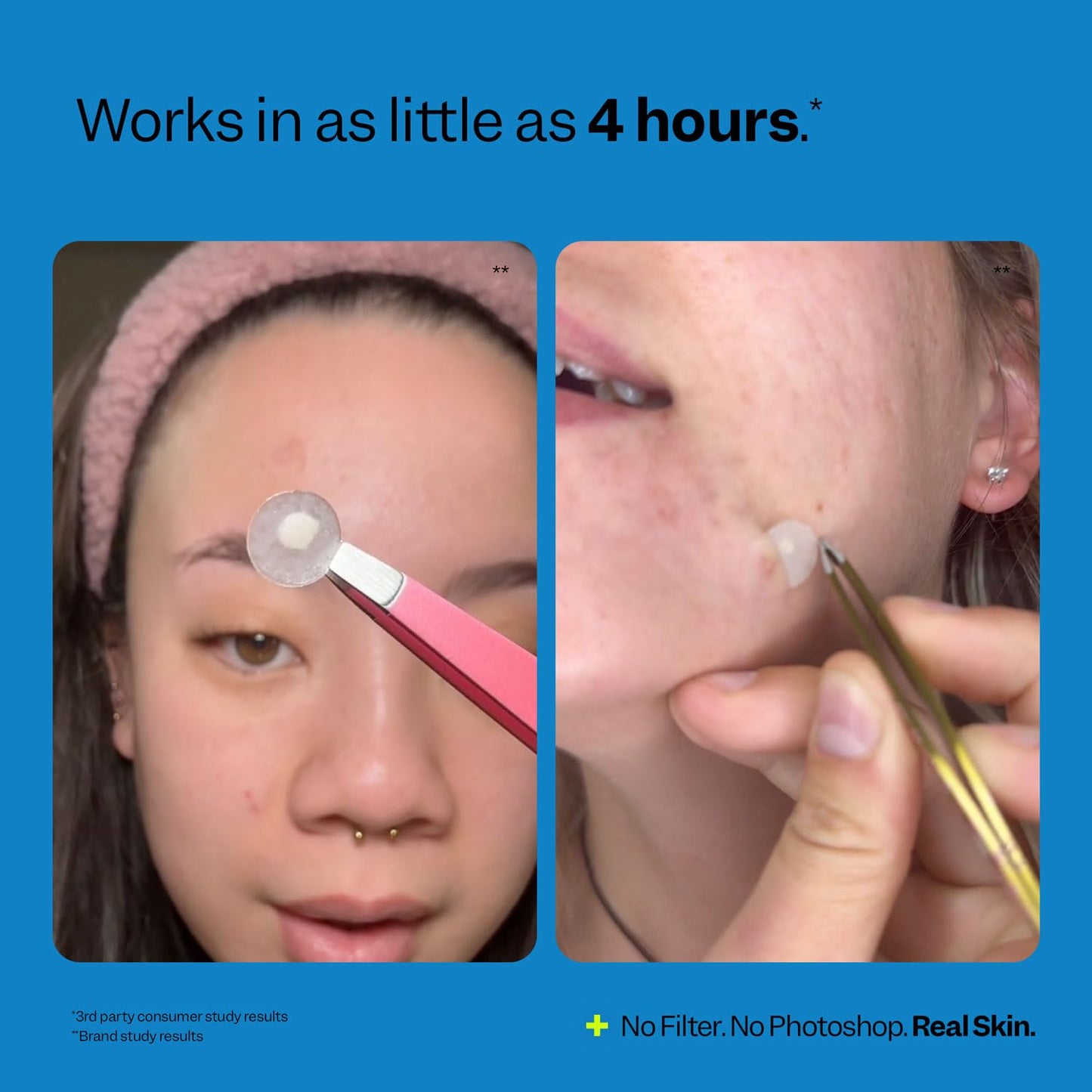 Peach Slices | Acne Spot Dots | Hydrocolloid Acne Patches | For Zits, Blemishes, & Breakouts | Vegan | Cruelty-Free | Pimple Patches | Facial Skin Care Products | 3 Sizes (7mm, 10mm, & 12mm) | 60 Ct