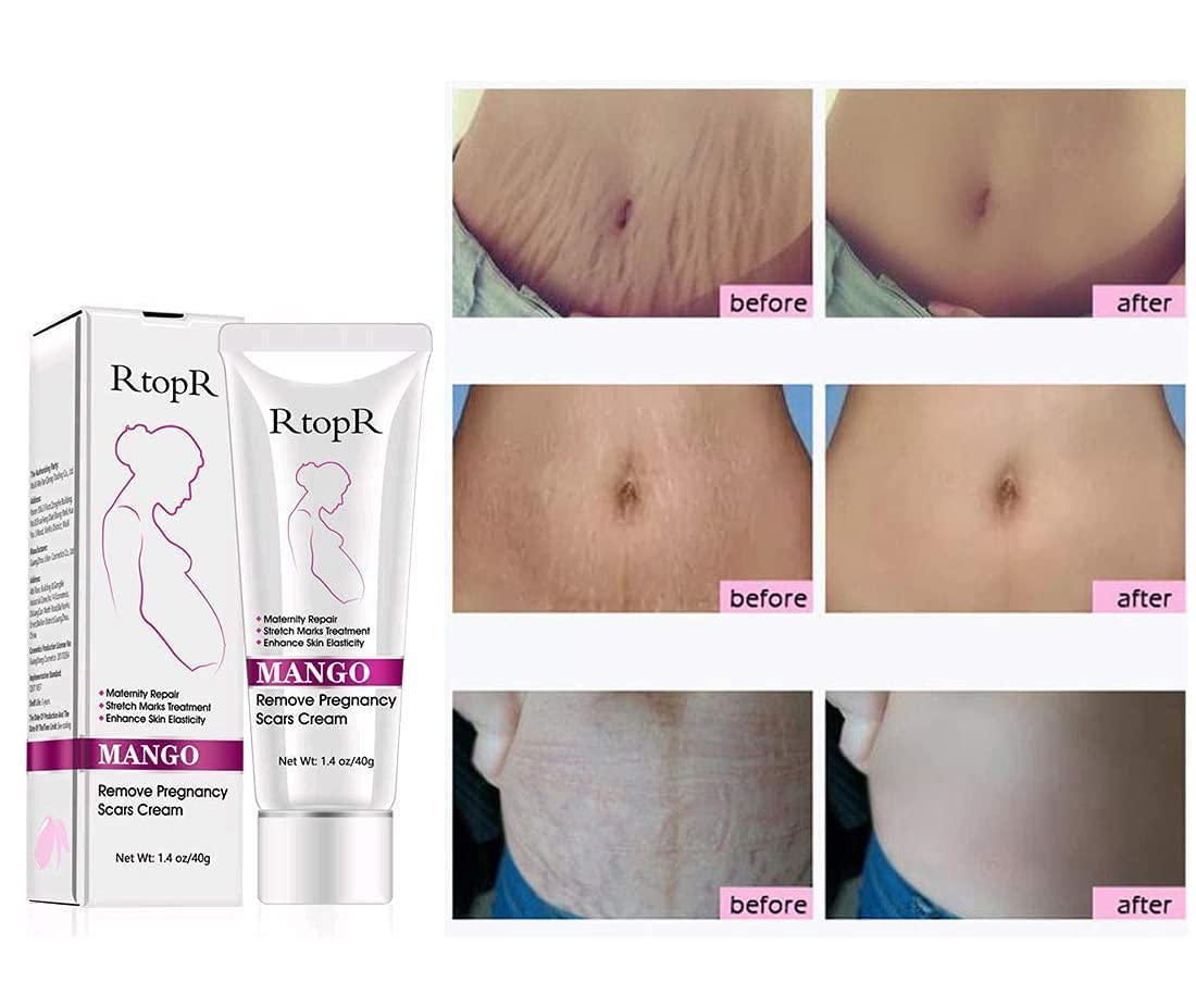 RtopR Mango Stretch Marks and Scar Cream -Stretch Marks and Scar Removal Cream for Pregnancy - Best Body Moisturizer-80g