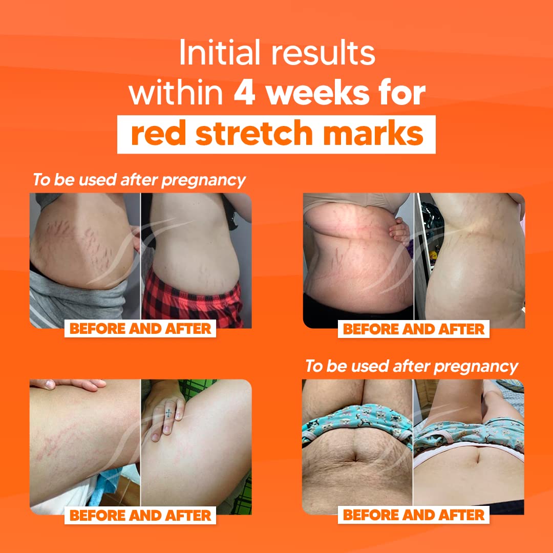 Cicatrissim Deep Stretch Mark Removal Cream - Innovative Formula With Pure and Powerful Natural Ingredients From Brazilian Flora - For All Stretch Marks & Skin Types.