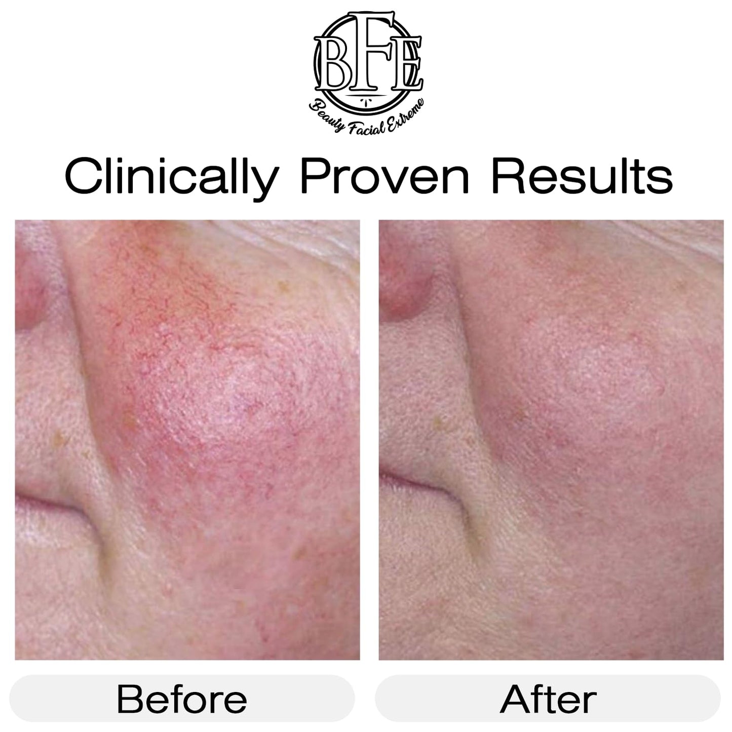 Vitamin K Cream- Moisturizing Bruise Healing Formula. Dark Spot Corrector for Bruising, Spider Veins & Broken Capillaries. Reduces Under Eye Dark Circles, Fine Lines, Puffiness, & Wrinkles.