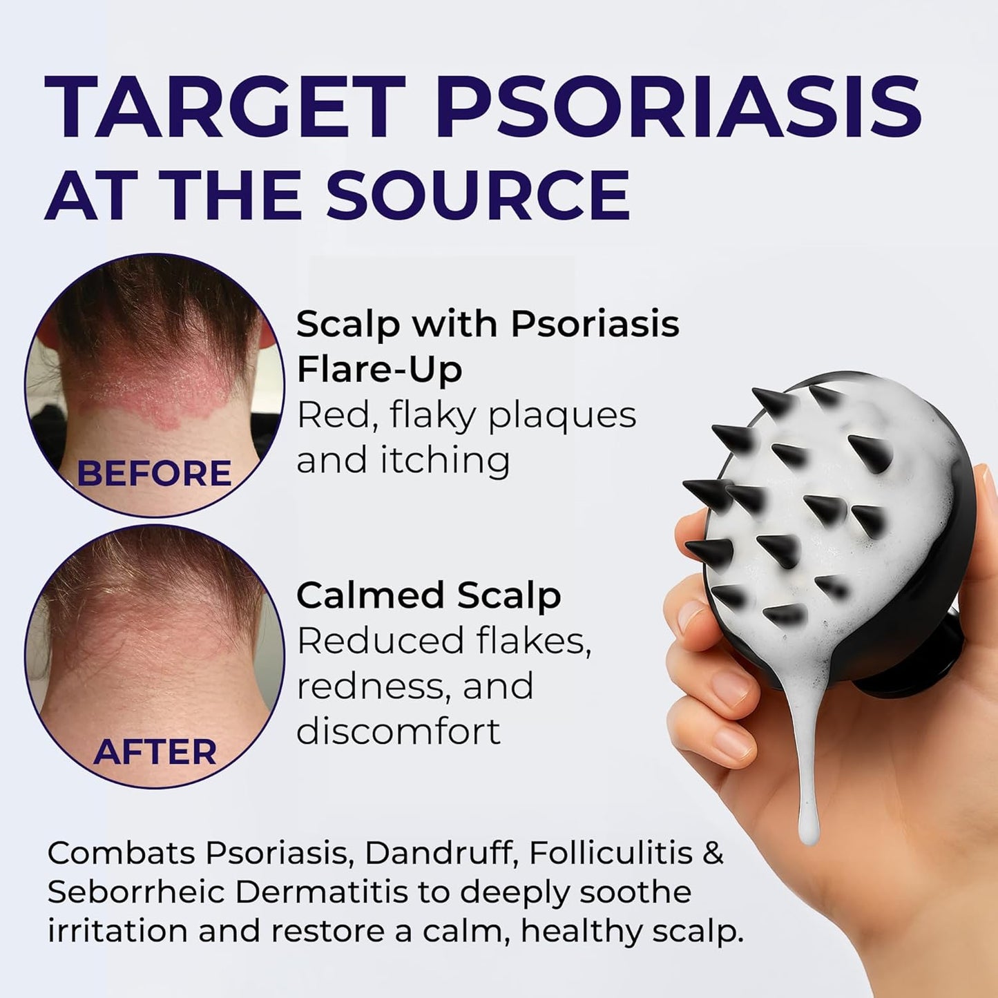 Flakes Shampoo Anti Dandruff - Medicated shampoo for Dandruff, Psoriasis, Seborrheic Dermatitis & Folliculitis Treatment - Anti Fungal Solution for Itchy, Flaky & Dry Scalp - 200ml