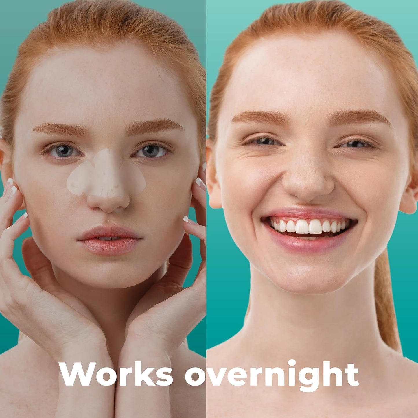 Pimple Patches for Nose (12 Pack), Cover Nose Pimples Overnight - Hydrocolloid Acne Patches - Pimple Patch Hydrocolloid Patches & Pimple Stickers, Nose Strip, Zit Patches