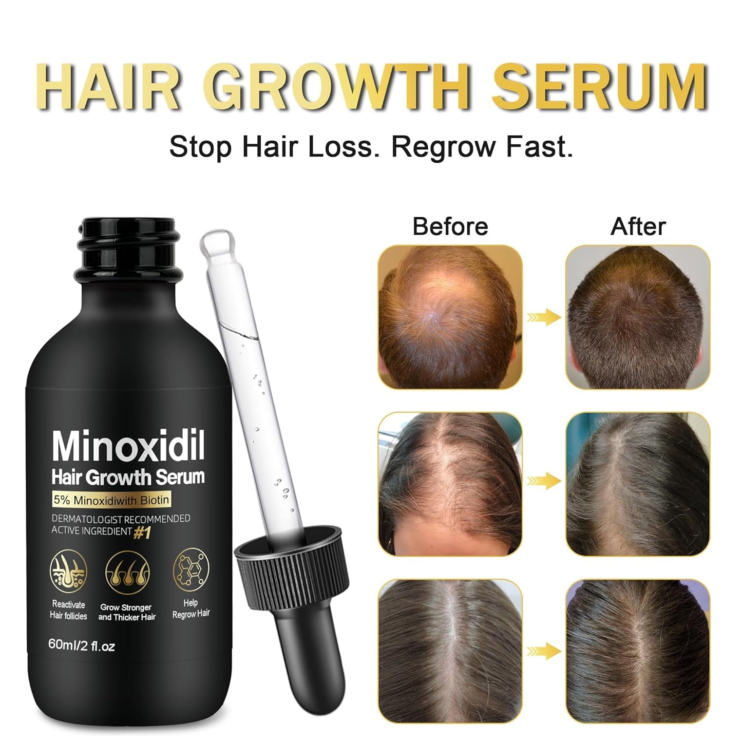 5% Minoxidil for Men and Women Hair Growth Treatment,Topical Minoxidil for Beard Growth, Hair Regrowth Serum for Scalp Hair Loss and Thinning, with Biotin (2 Fl Oz (Pack