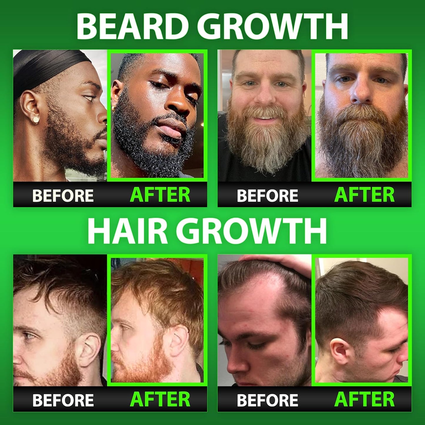 Beard Growth Kit w/ 6X Liquid BIOTIN Supplement with Collagen Peptides + 620,000mcg BIOTIN Gummies Beard Growth Vitamins & Hair Growth Vitamins for Men